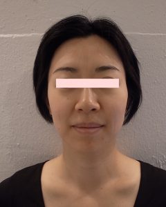 Face before
