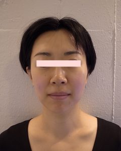 Face after